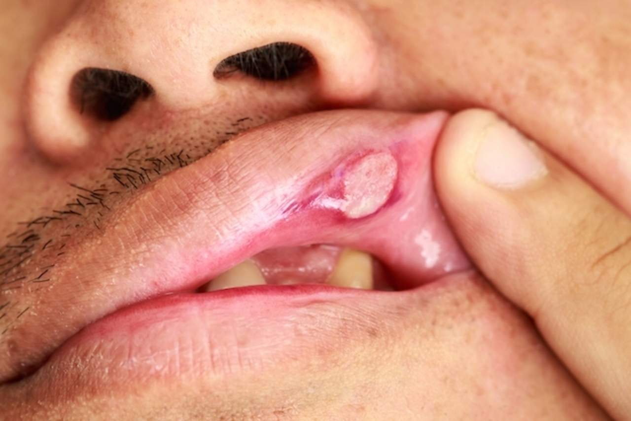 Herpes labial puede pasar a genitales